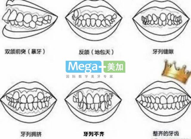 隐形矫正需要拔牙吗