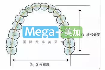 隐形矫正需要拔牙吗