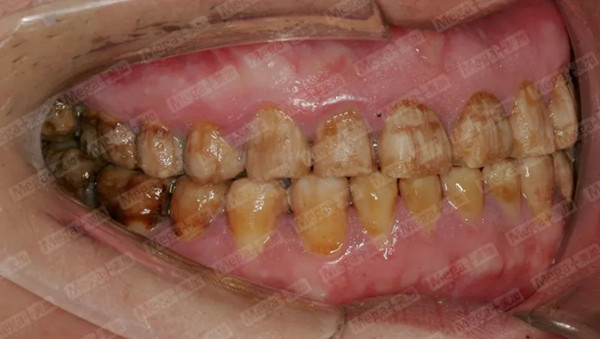 美加牙贴面案例：中重度四环素牙全口美白后，颜值暴涨！
