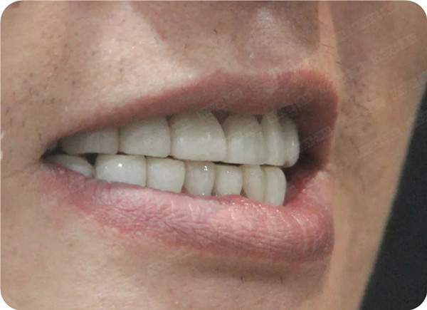 美加牙贴面案例：中重度四环素牙全口美白后，颜值暴涨！