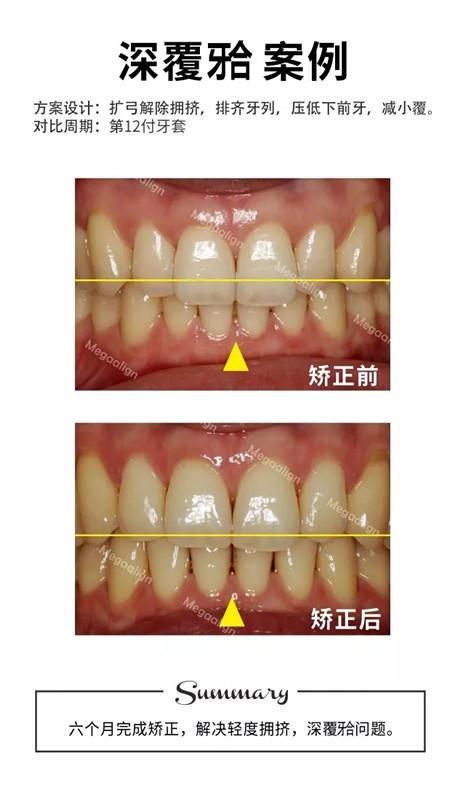 易齐隐形矫正案例