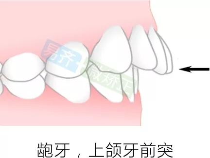 易齐微矫正方案：龅牙，上颌牙前突