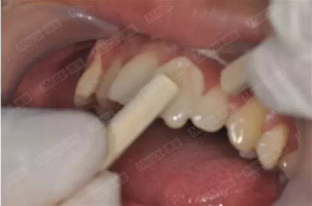 美加案例丨牙齿缺损，美加瓷贴面修复案例一则