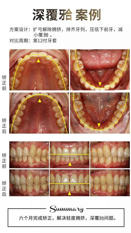 易齐隐形矫正案例