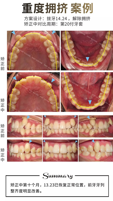 易齐隐形矫正案例