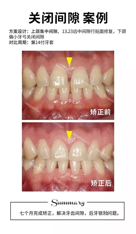 易齐隐形矫正案例