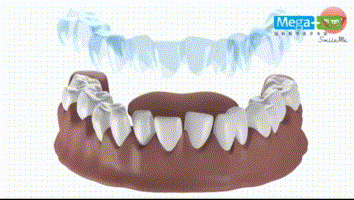 一分钟了解透明牙套的隐形矫正原理！