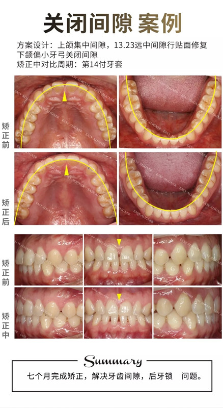 易齐隐形矫正关闭牙缝隙案例