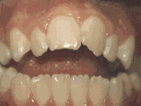 牙齿矫正小动图