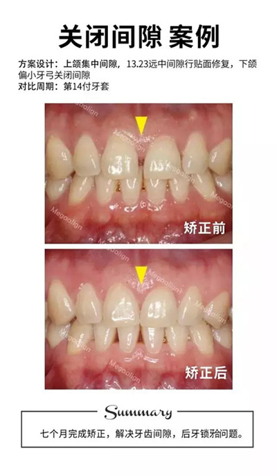 隐形矫正关闭牙缝案例