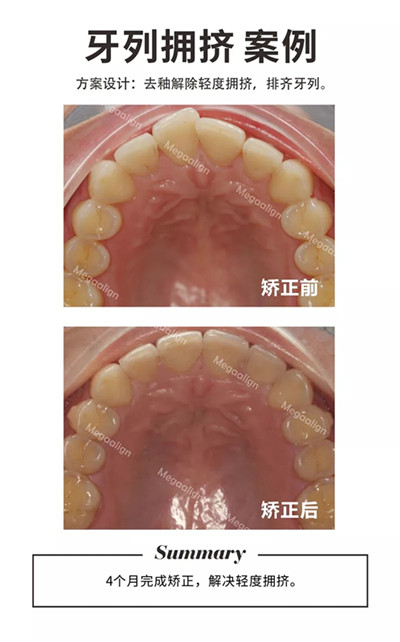 牙齿矫正-牙列拥挤案例