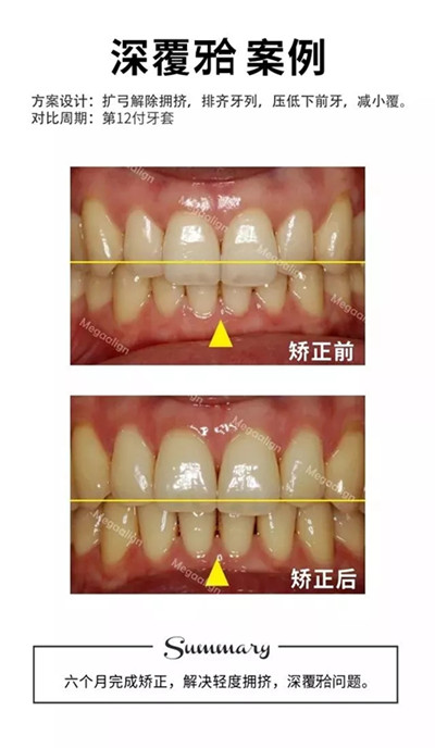 隐形矫正-深覆合案例