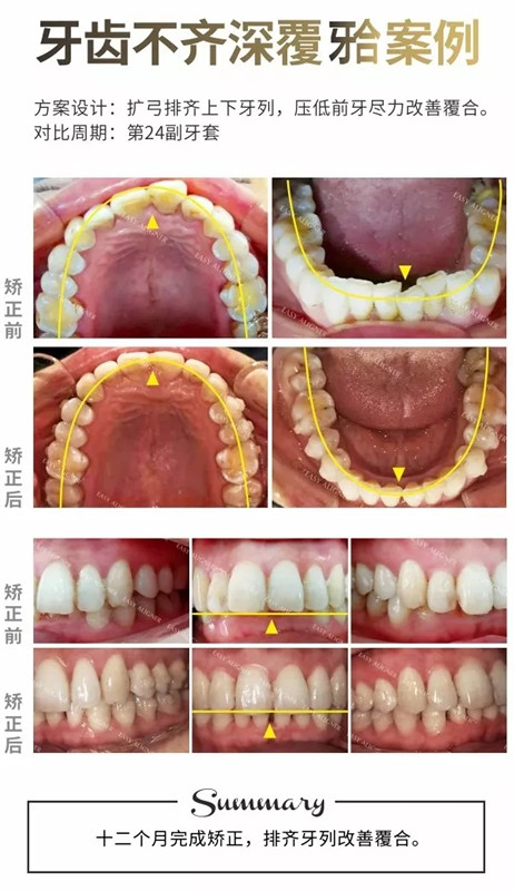 牙齿深覆合矫正前后对比