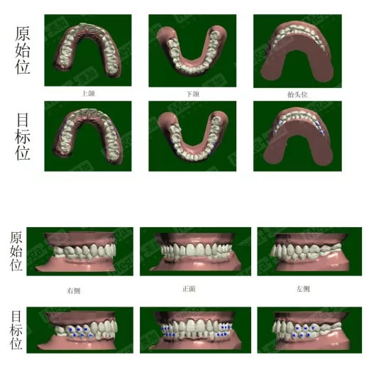 矫正方案设计