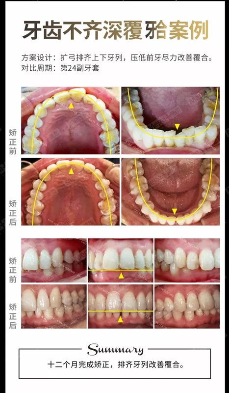 牙齿不齐深覆颌案例