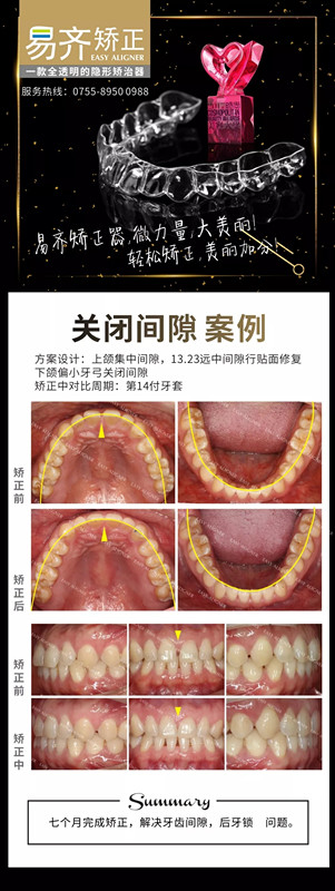 美加易齐透明矫正关闭牙缝案例