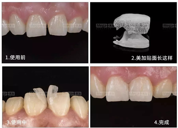 美加超薄美牙贴面