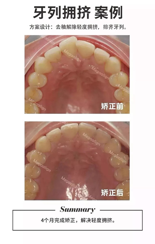 易齐微矫正案例分享