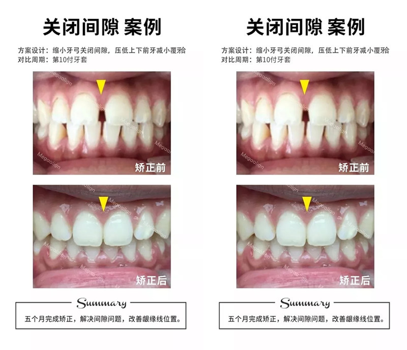 美加易齐微矫正案例分享