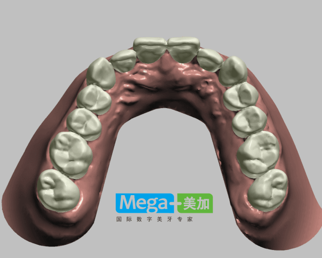 隐形矫正效果可视化