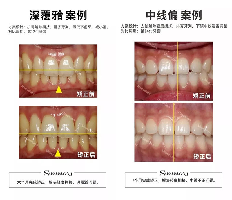 易齐微矫正案例