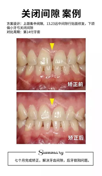 美加易齐隐形矫正关闭牙缝案例