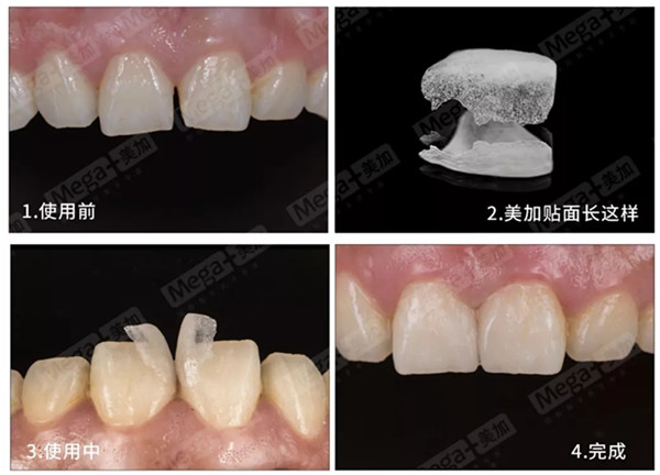 美加超薄美牙贴面