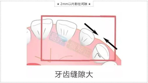 牙齿缝隙大