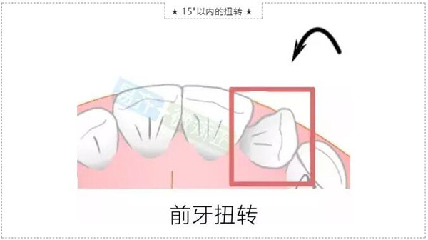 前牙扭转