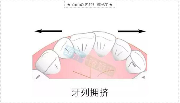 美加易齐微矫适应症