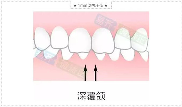 美加易齐微矫适应症