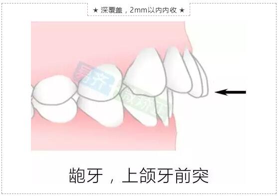 美加易齐微矫适应症