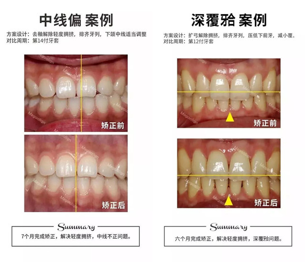 美加易齐微矫案例