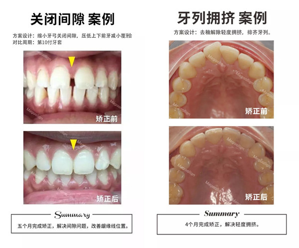 美加易齐微矫案例