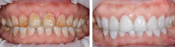 氟斑牙修复案例 4