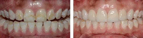 氟斑牙修复案例 5
