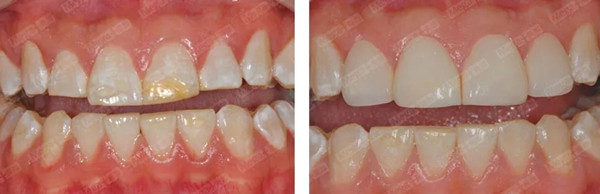 氟斑牙修复案例 6