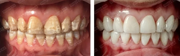 氟斑牙修复案例 7
