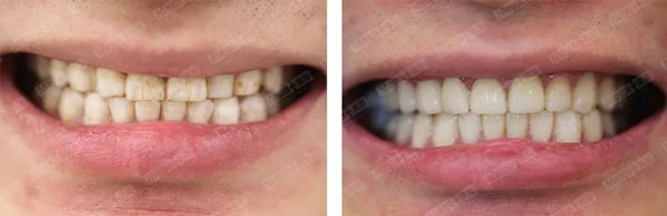 氟斑牙修复案例 8
