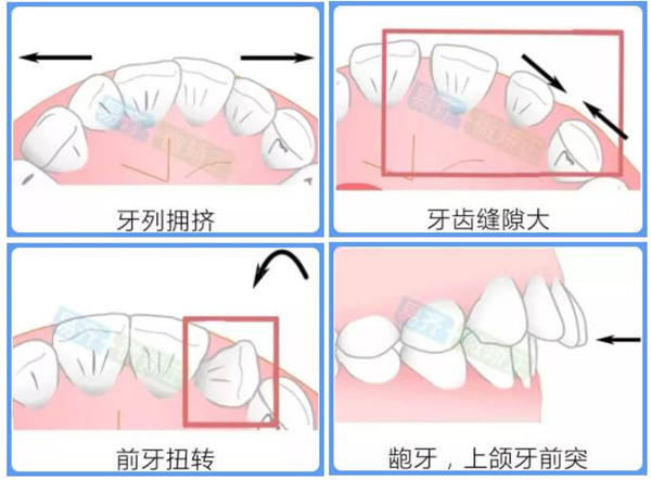 易齐微矫适应症