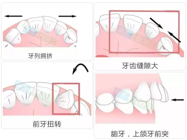 易齐微矫适用范围