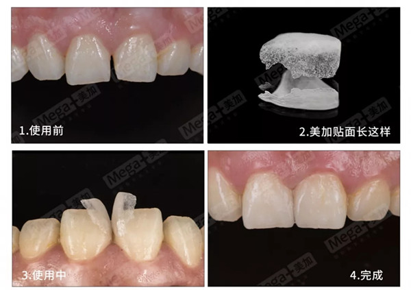 什么是牙贴面？它能用来干嘛？