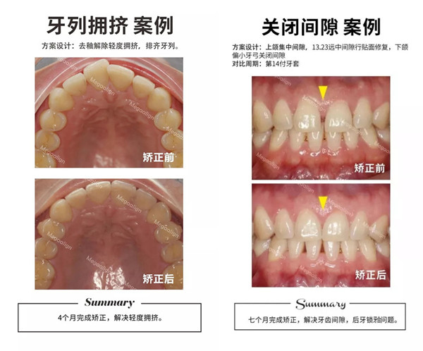 这样的牙齿都适合用易齐微矫正