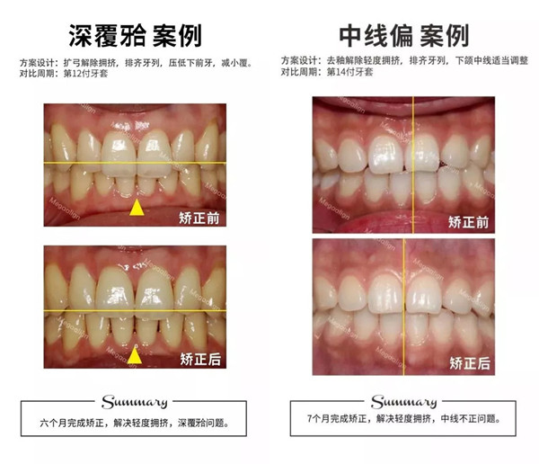 这样的牙齿都适合用易齐微矫正