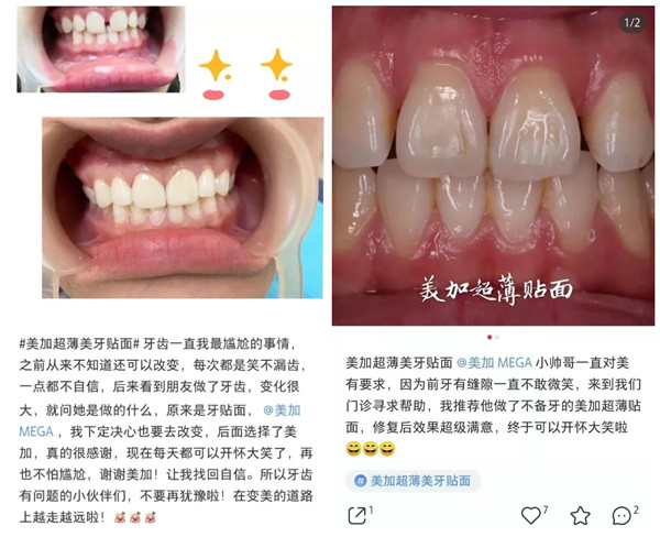 小红书上那么多人在用的美加贴面，我该怎么买？