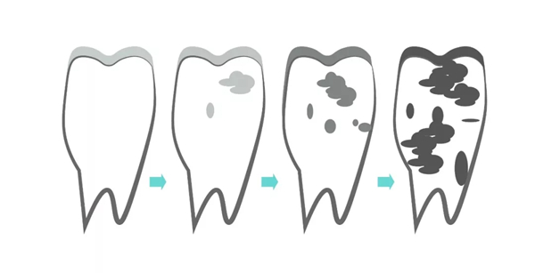 两大祸首：龋病和牙周疾病