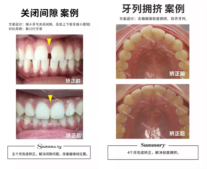 美加易齐微矫案例