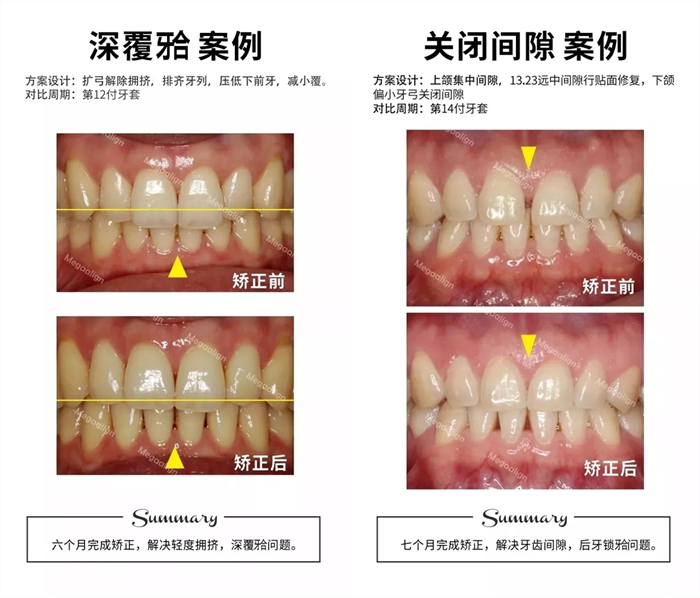 美加易齐微矫案例