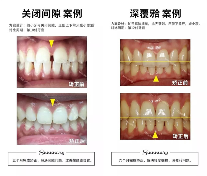 美加易齐微矫案例