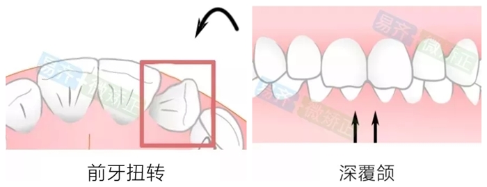 易齐微矫适应症